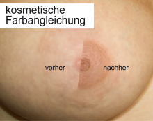 Brustpigmentierung wie sie im Bereich der plastischen Schönheitschirurgie angewendet werden kann | KroMED Hamburg